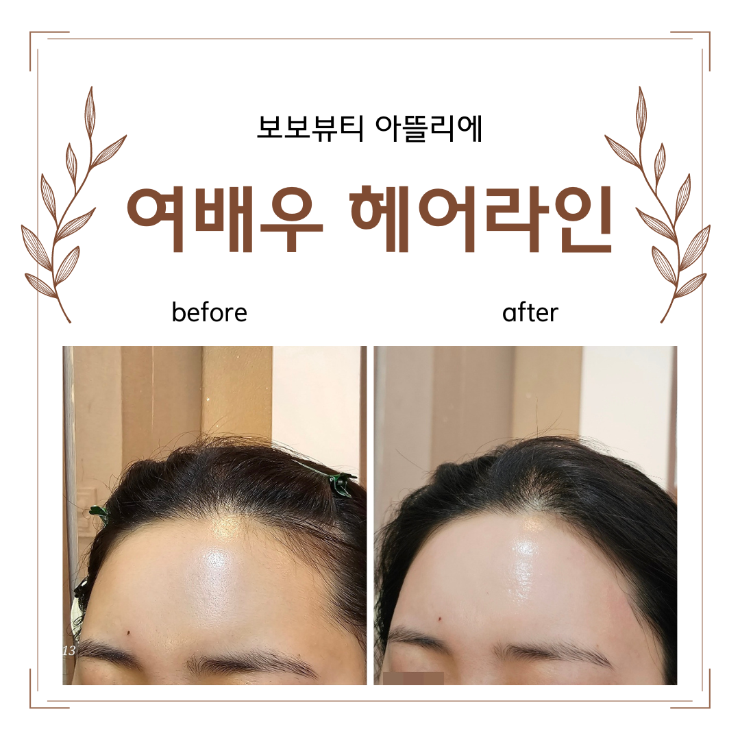 230825 헤어라인2 - 블로그.png